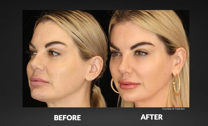 Premium Botox Clinic - Cardiff