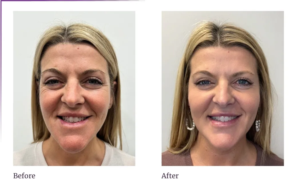 Botox Training Course